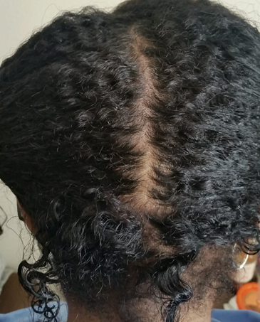 Scalp Stimulation